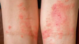 Dermatitis Treatment