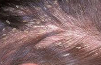 Hair Scalp Disorder Image
