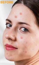 Before Acne HF