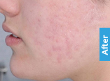 After Acne Treatment