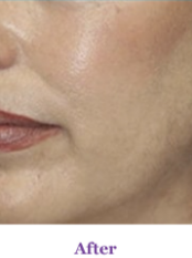 After Laser Toning