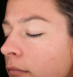 After Skin Toning