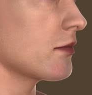 What is Albinism
