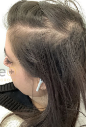 About Alopecia