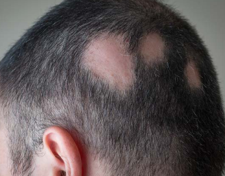Alopecia Treatment Image