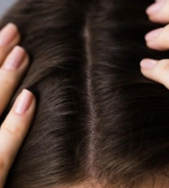 Dandruff Causes