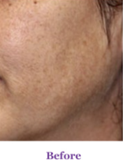 Before Laser Toning