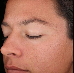 Before Skin Toning
