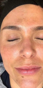 After Body Peel