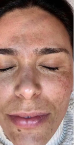 Before Body Peel