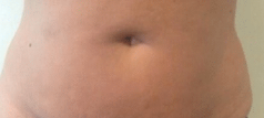 Fat Freezing Vasai