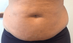 Fat Freezing Vasai