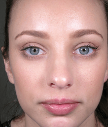 After Face Lifting