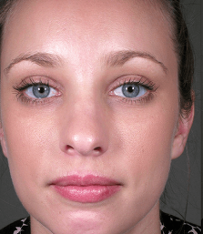 Before Face Lifting