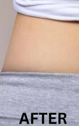 After Fat Melting