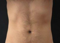 After Fat Freezing
