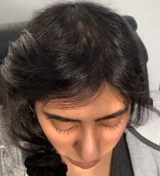 After Mesotherapy