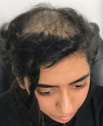 Before Mesotherapy