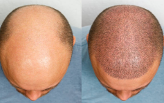 Clinic Hair Transplant Session