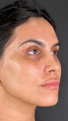 Before Hydra Facial
