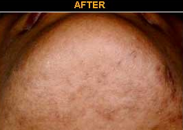 Ingrown Hair Info