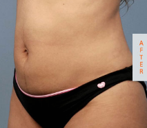 After U‑Lipo