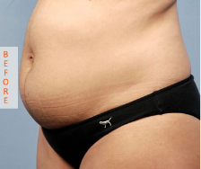 Before U‑Lipo