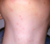 After Treatment