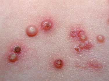 Before Treatment