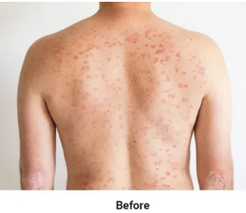 Before Psoriasis Treatment