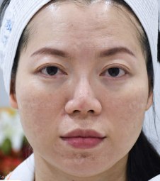 After Treatment