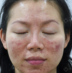 Before Treatment