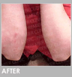 After Treatment