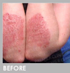 Before Treatment