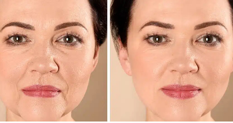 Skin Tightening Treatment