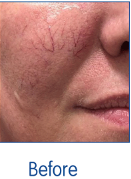 Before Treatment