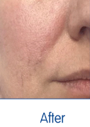 After Treatment